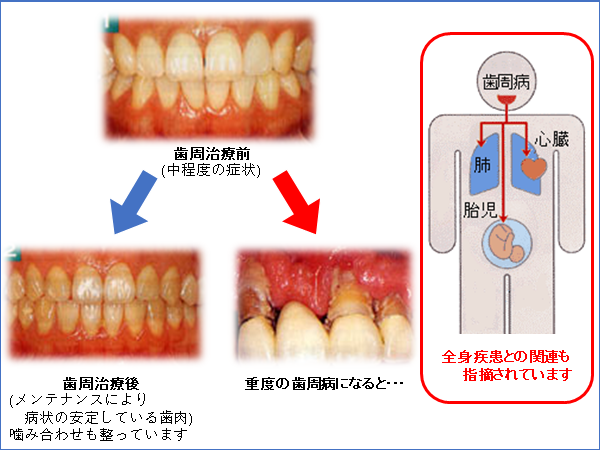 歯周病大４