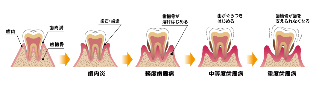歯周病進行