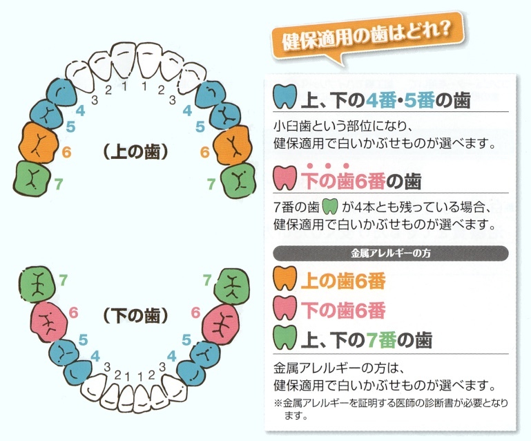 銀歯が気になる方へ