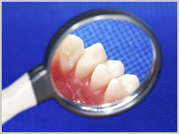 案内_歯周病治療