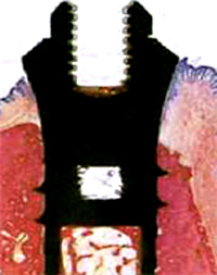 インプラント|山田歯科クリニック