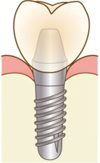 implant-compare001_コピー_コピー