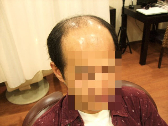 部分かつら(オーダーメイド)_Before