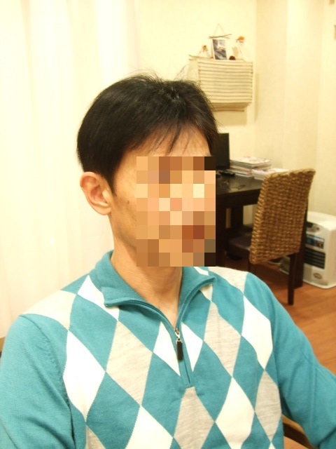 部分かつら(オーダーメイド)After