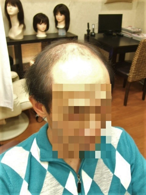 部分かつら(オーダーメイド)Before