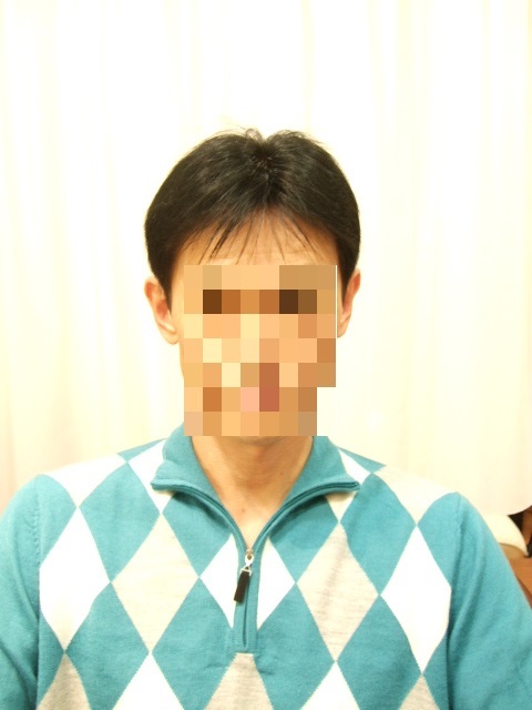 部分かつら(オーダーメイド)After