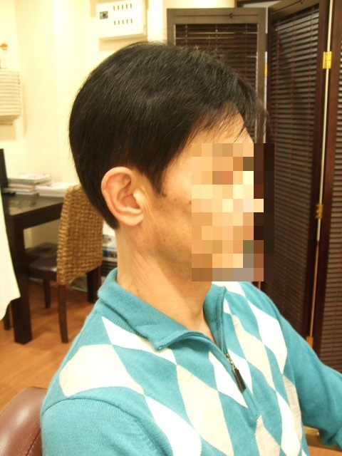 部分かつら(オーダーメイド)After