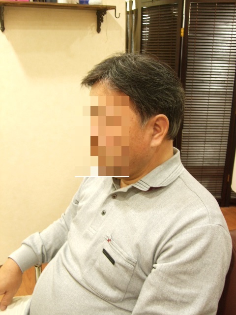 部分かつら(オーダーメイド)After