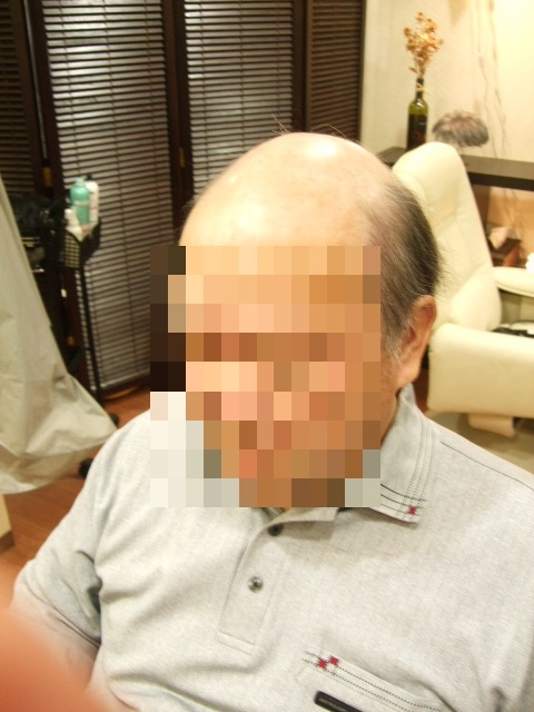 部分かつら(オーダーメイド)Before