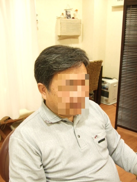 部分かつら(オーダーメイド)After