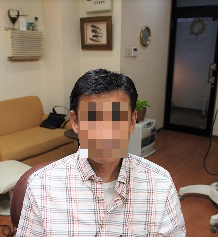 部分かつら(オーダーメイド)