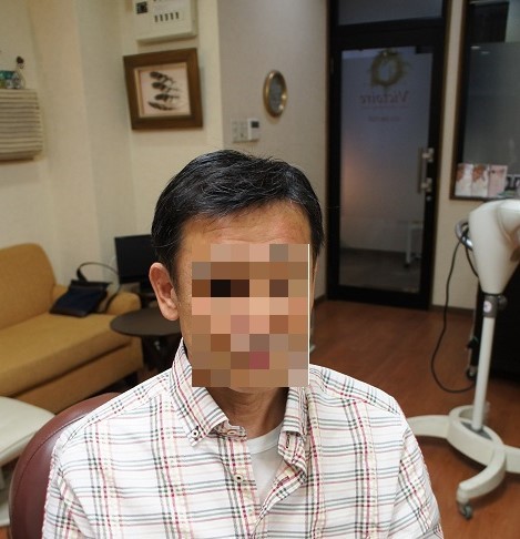 部分かつら(オーダーメイド)