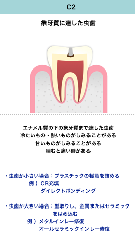 虫歯の進行と症状