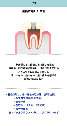 虫歯の進行と症状