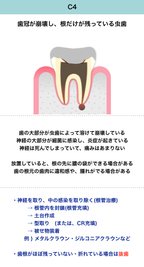 虫歯の進行と症状