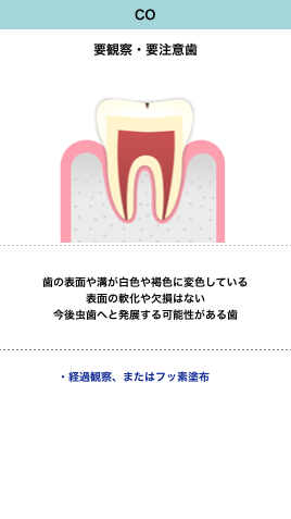 虫歯の進行と症状