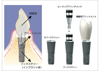 インプラント治療