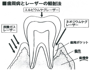 歯周病|小早川歯科クリニック