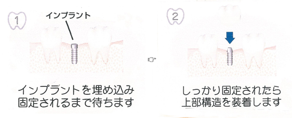 インプラント|小早川歯科クリニック