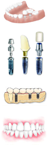 implant08