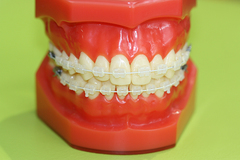 マルチブラケット・小児矯正