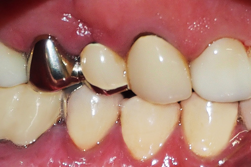smilecrown02