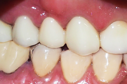 smilecrown03