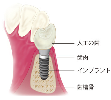 implant01