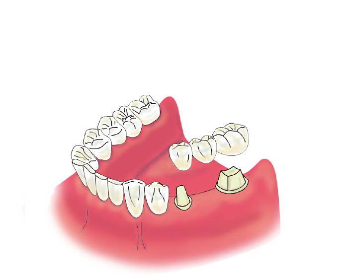 implant02
