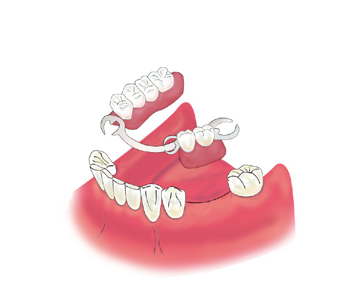 implant03