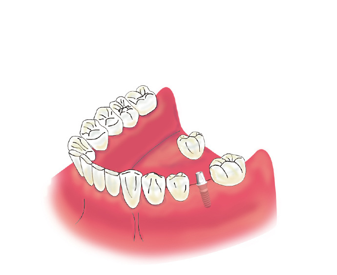 implant05