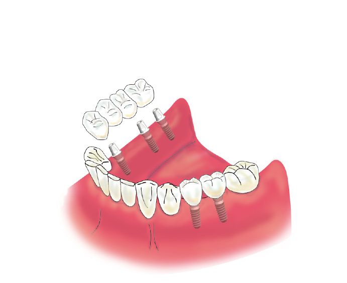 implant06