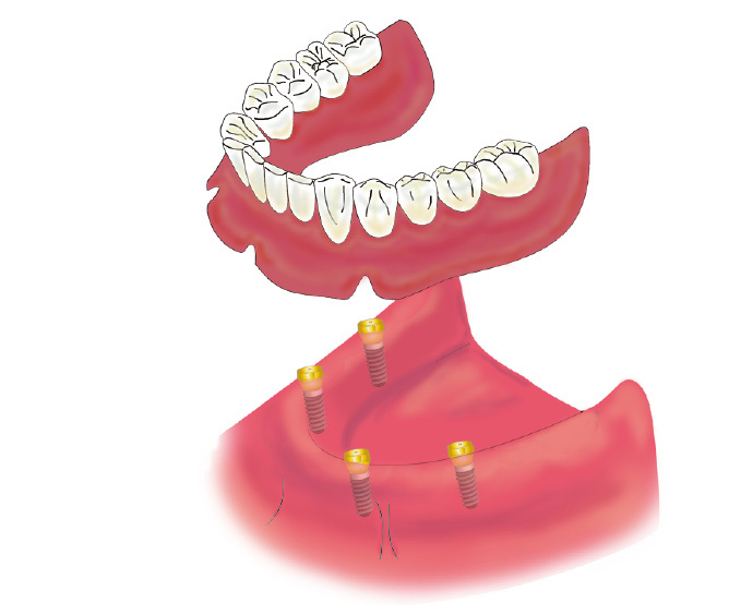 implant07