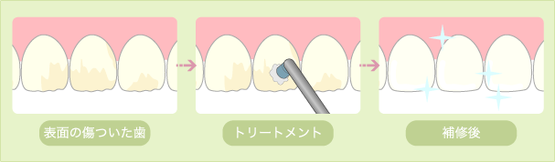歯面トリートメント