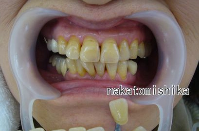 ホワイトニング症例01-1