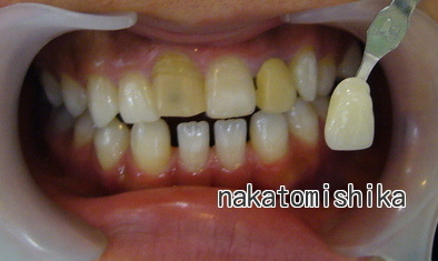 ホワイトニング症例02-2