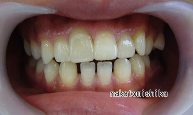 ホワイトニング症例02-3