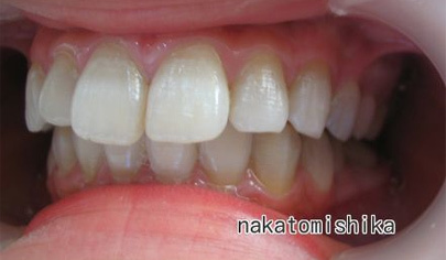 ホワイトニング症例03-2