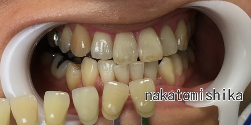 ホワイトニング症例04-1