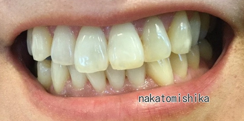 ホワイトニング症例04-2
