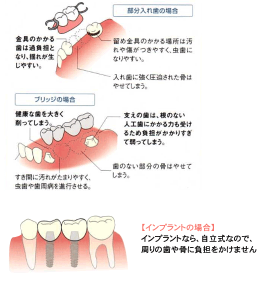 インプラント2