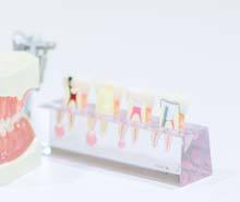 虫歯1_虫歯の進行段階とその治療法
