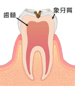 虫歯4_歯の中(象牙質)の虫歯