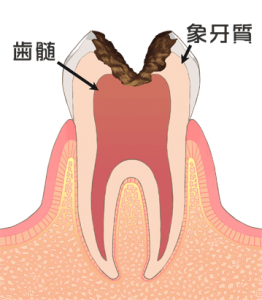 虫歯5_神経まで進行した虫歯