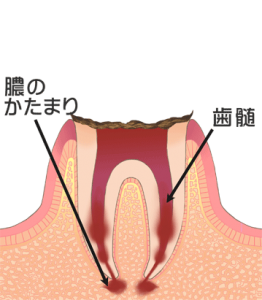 虫歯6_歯の根まで進行した虫歯