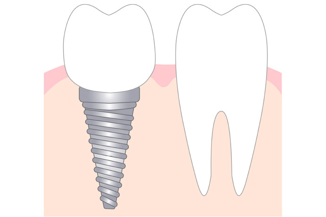 自費_インプラント1