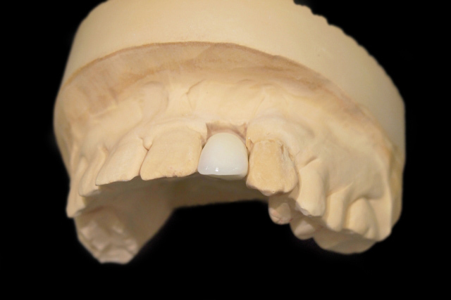 自費_インプラント2