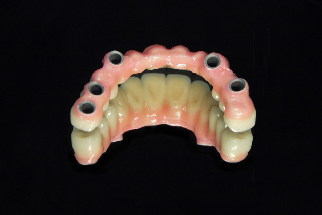 自費_インプラント3