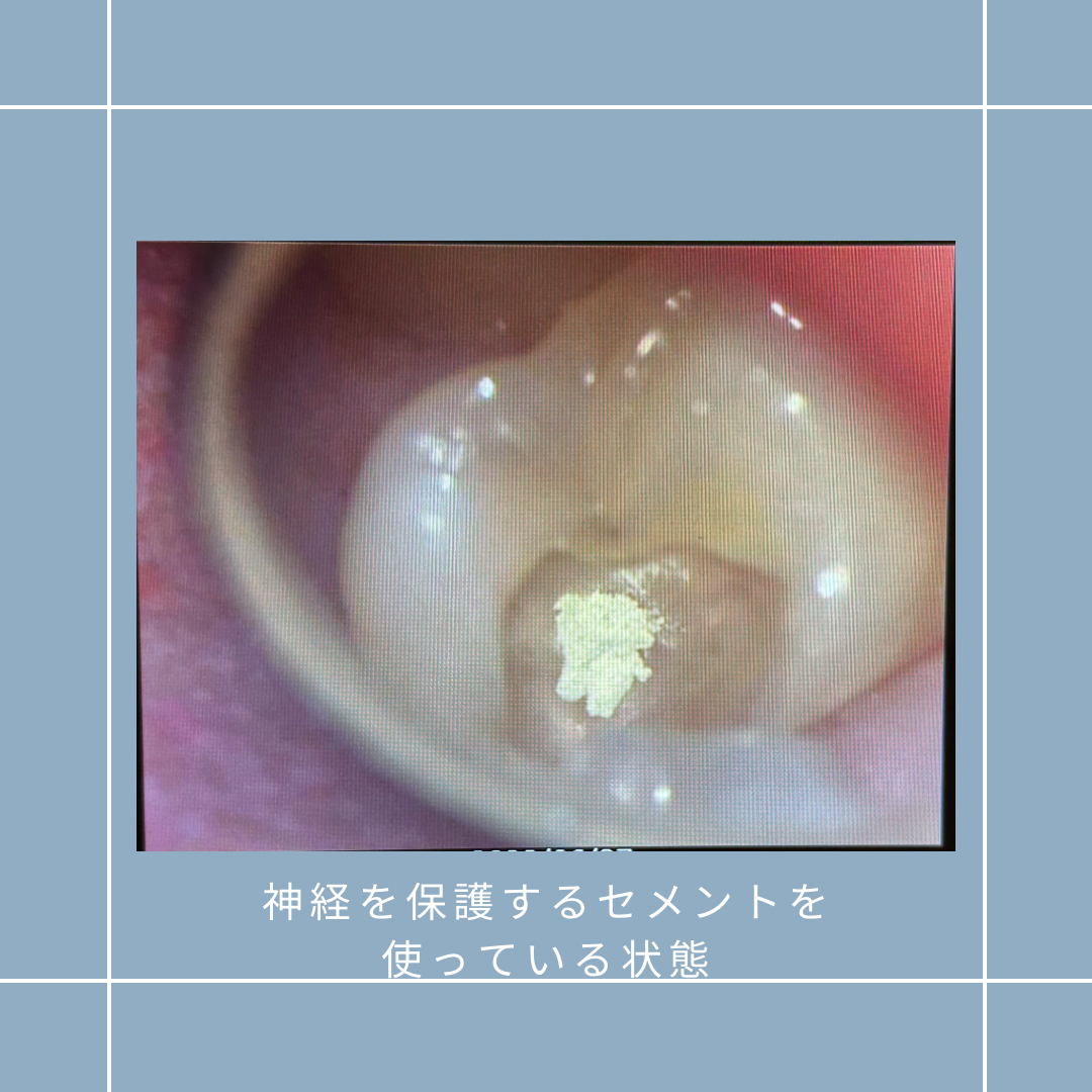 歯髄保存できます。