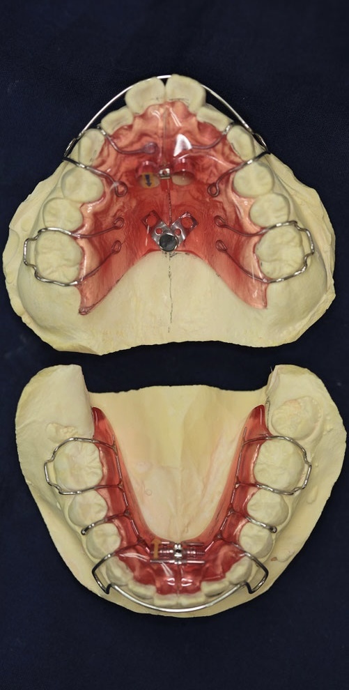 床矯正について、小児に主にやっています。